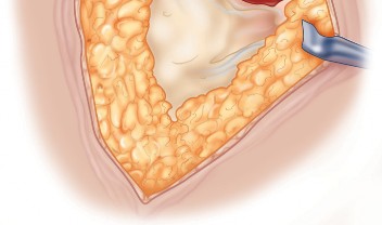 Illustration 7 for Unlock the Figure Posterior Approach to the Hip