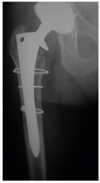 Illustration 9 for Revision THA: Why Extensively Porouscoated Cylindrical Stems Excel