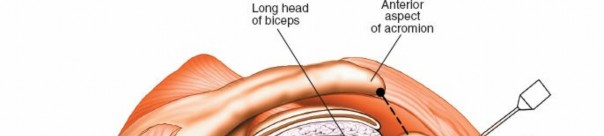 Illustration 222 for Essential Guide: Mastering Every Approach to the Shoulder