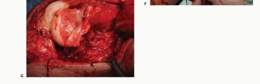 صورة طبية: النقائل العظمية الفخذية: دليل شامل للعلاج واستعادة الوظيفة مع الأستاذ الدكتور محمد هطيف في صنعاء