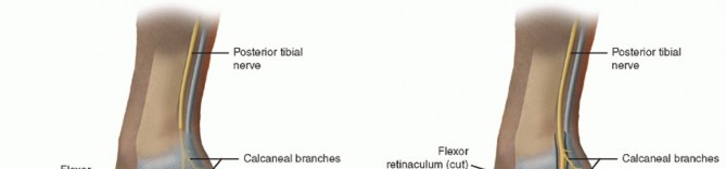 Illustration of distal tarsal tunnel - Dr. Mohammed Hutaif