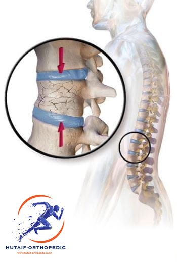 كسور الفقرات الانضغاطية