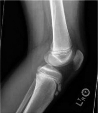 Illustration 3 for 18 Pediatric Cases: Single Sport Specialization Risks Unpacked