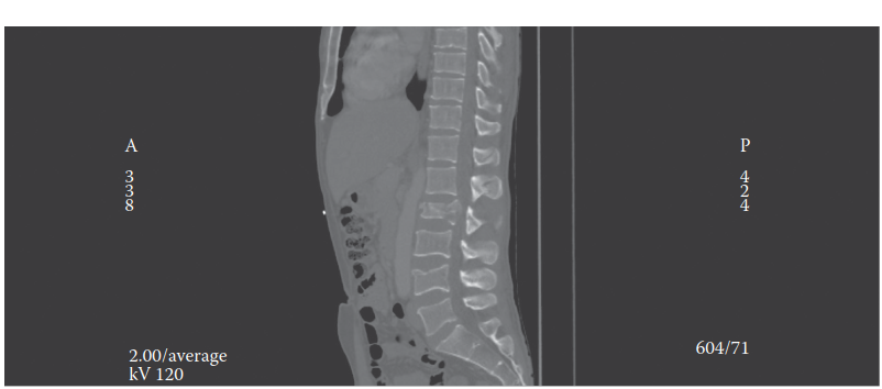 Illustration of thoracolumbar spine injury - Dr. Mohammed Hutaif