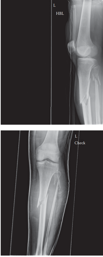 Proximal Tibial Diaphyseal Fracture: High-Energy Trauma Case Study & Clinical Diagnostics