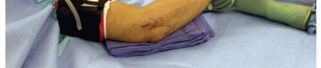 Illustration of extensor carpi ulnaris - Dr. Mohammed Hutaif