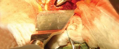 Illustration 21 for Posterolateral Surgical Approaches: Achieve Optimal Hip Replacement