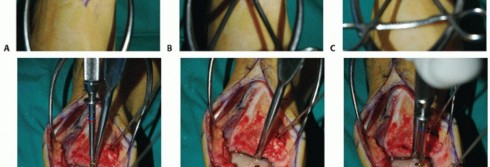 Illustration 39 for Unlock Healing: Medial Malleolar Osteotomy for Talus OLT Allografts