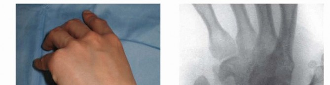 Percutaneous Fixation of Acute Scaphoid Fractures