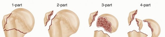 Illustration of humerus fractures open reduction - Dr. Mohammed Hutaif