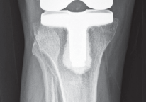 Illustration 36 for Minimize Pain, Maximize Recovery: TKA with Parapatellar