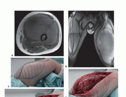 صورة طبية: استئصال ساركوما العضلة الرباعية مع الحفاظ على الطرف: دليل شامل للمرضى مع الأستاذ الدكتور محمد هطيف في صنعاء