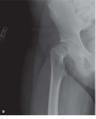 Illustration 2 for Mastering Pediatric SCFE: How to Properly Engage the Epiphysis