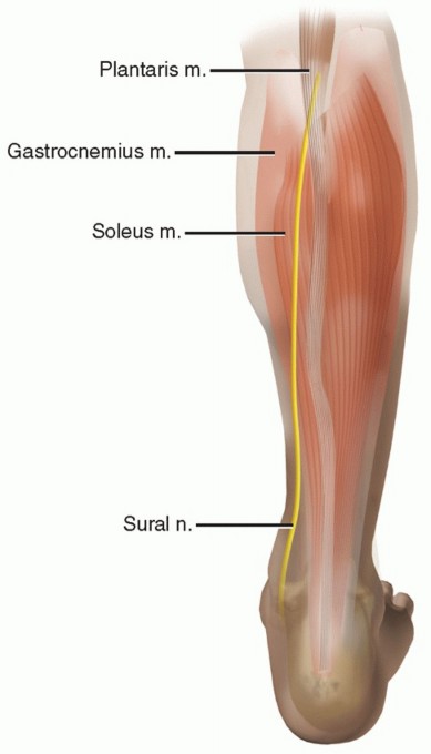 Percutaneous Achilles Tendon Repair: Understanding the Approach