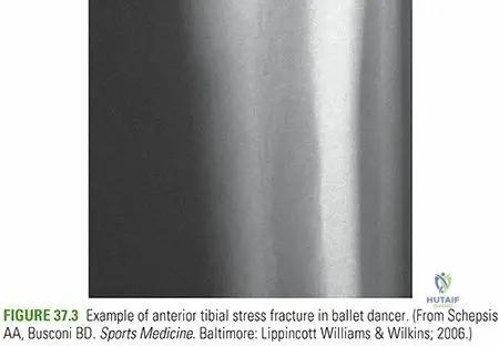 Illustration of tibiafibula shaft fractures - Dr. Mohammed Hutaif