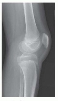 Illustration of osteotomy for crouch - Dr. Mohammed Hutaif