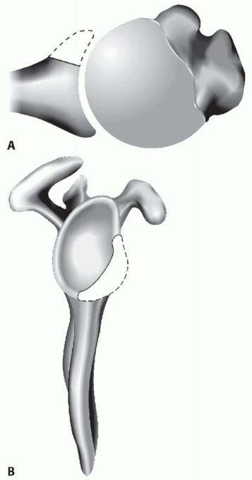 Illustration 4 for Glenoid Bone Graft for Anterior Shoulder Instability: Restore Stability