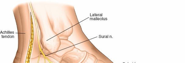Mastering the Lateral Approach to the Calcaneus for Fracture Repair