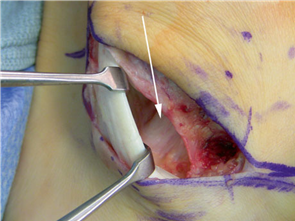 Illustration 20 for First Metatarsal Surgery: Expert Solutions for Foot & Ankle Pain
