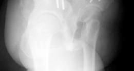 Illustration 9 for Periacetabular Osteotomy: End Hip Pain, Improve Flexion and Internal Motion