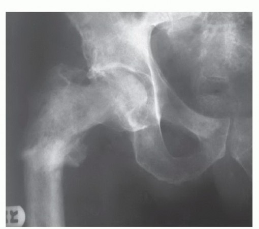 Illustration 11 for Beyond Amputation: Total Femur Resection with Endoprosthetics