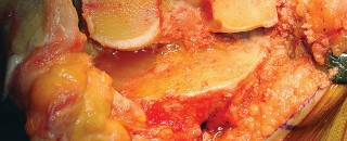 Illustration 21 for Mastering TKA: Essential Methods of Rotational Alignment