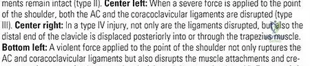 Illustration of clavicle strap sling - Dr. Mohammed Hutaif