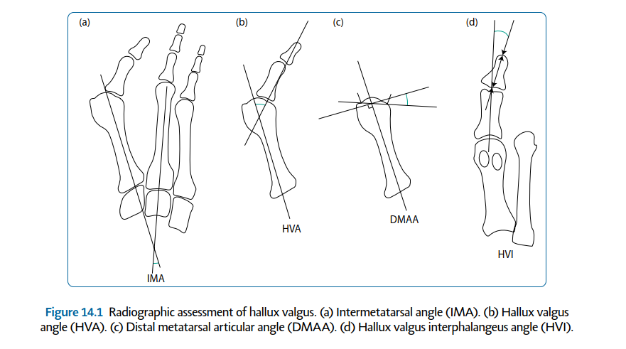 First Metatarsophalangeal Joint Surgery: Understanding Your Options