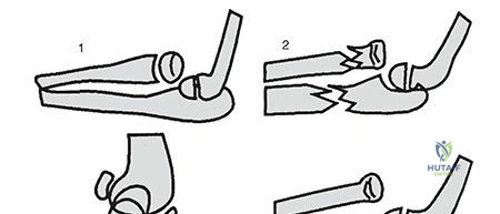 Illustration of long arm cast - Dr. Mohammed Hutaif
