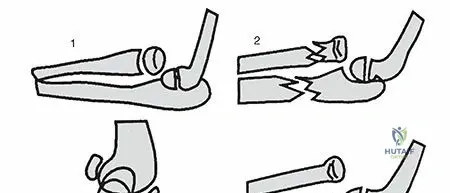 Illustration of long arm cast - Dr. Mohammed Hutaif