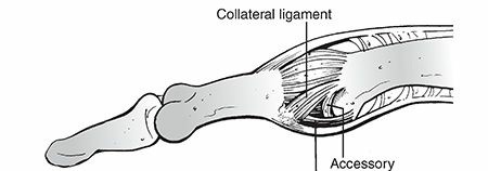 CRIF vs ORIF for Hand Fractures: Understanding Your Treatment Options