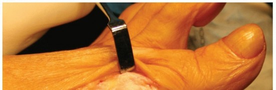 Proximal Opening Wedge: Effective Hallux Valgus Correction