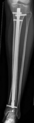 Illustration 33 for Tibial Fracture Extending into the Plafond: Intramedullary Secrets