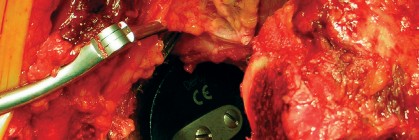 صورة طبية: طول عمر مكون الحُق الأسمنتي في مفصل الورك: مفتاح الاستقرار والديمومة مع الأستاذ الدكتور محمد هطيف في صنعاء