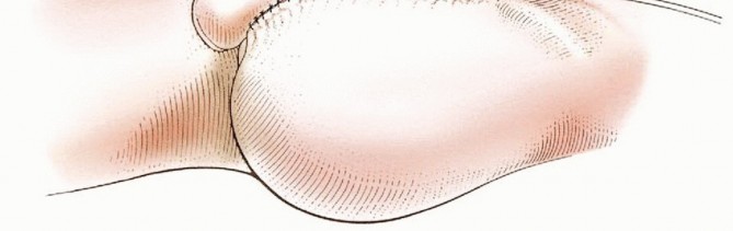 صورة طبية: استئصال مفصل الورك: دليل شامل للمرضى مع الأستاذ الدكتور محمد هطيف