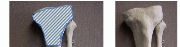 Mastering Intramedullary Nailing of Metaphyseal Tibia Fractures