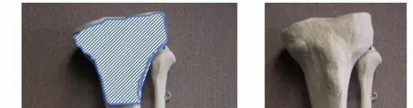 صورة توضيحية لـ كسور قصبة الساق (عظم الساق): الأسباب، الأعراض، وطرق العلاج الحديثة في اليمن