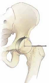 Periacetabular Osteotomy: What It Is & How It Works
