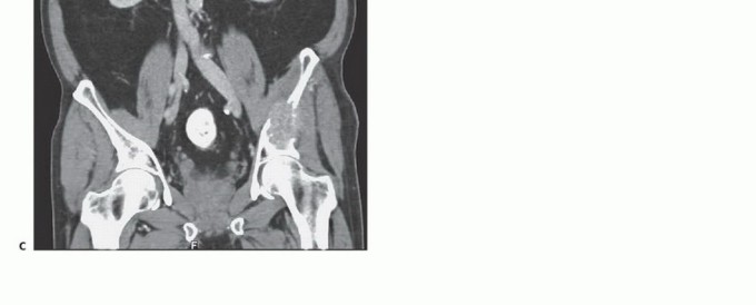 توضيح طبي: جراحة نقائل الحوض: حل شامل لآلام العظام واستعادة الحركة مع الأستاذ الدكتور محمد هطيف