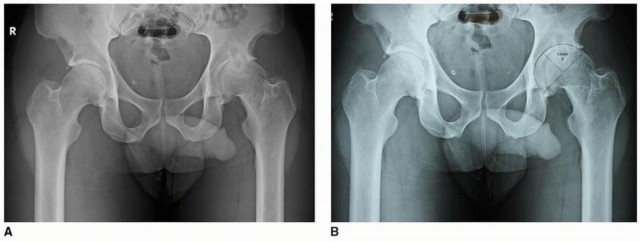 Illustration of socket the uncemented - Dr. Mohammed Hutaif