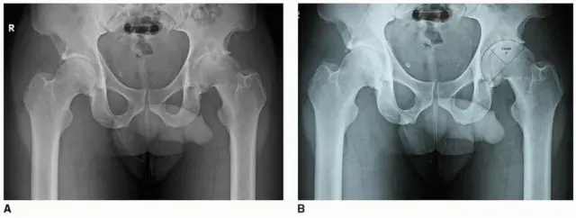 صورة توضيحية لـ تثبيت مفصل الورك بدون أسمنت: دليل شامل لمرضى استبدال الورك مع الأستاذ الدكتور محمد هطيف