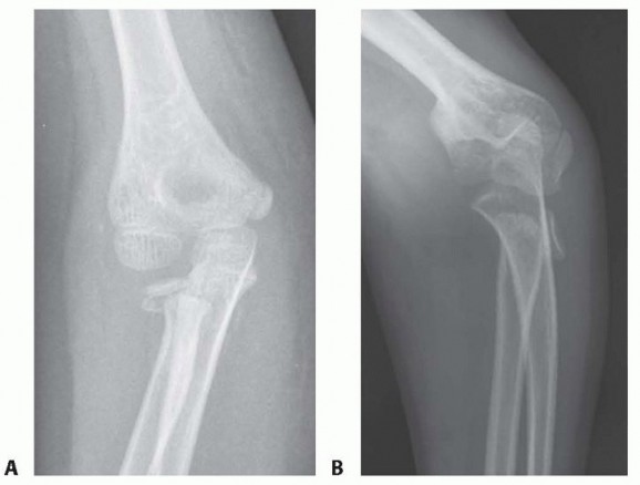 Illustration of radial neck fracture - Dr. Mohammed Hutaif