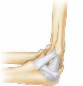 Solving Arthroscopic Valgus Instability: Regain Elbow Stability