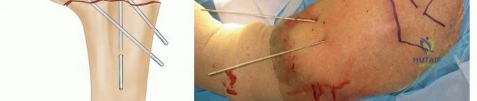 صورة توضيحية لـ تطويل الأطراف: رحلة الأمل نحو حياة أفضل وأفق جديد مع الأستاذ الدكتور محمد هطيف