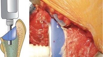 توضيح طبي: استبدال مفصل الورك الكلي بتقنية الإسمنت للفخذ: دليلك الشامل لنتائج تدوم طويلاً مع الأستاذ الدكتور محمد هطيف في صنعاء