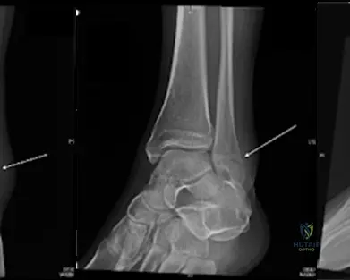 Ankle Fractures: Comprehensive Guide to Epidemiology, Classification, Anatomy & Biomechanics
