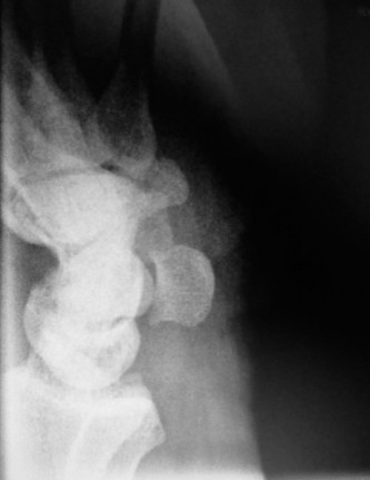 Illustration 11 for Christine M Kleinert Discussion: Solving Difficult Wrist Fractures