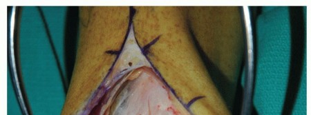 Illustration 25 for Unlock Healing: Medial Malleolar Osteotomy for Talus OLT Allografts