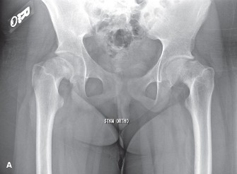 Mastering Pediatric SCFE: How to Properly Engage the Epiphysis