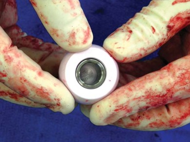 صورة طبية: تقنية الجذع القصير لاستبدال مفصل الورك الكلي: نهج الأستاذ الدكتور محمد هطيف لتدخل جراحي أقل ونتائج أفضل